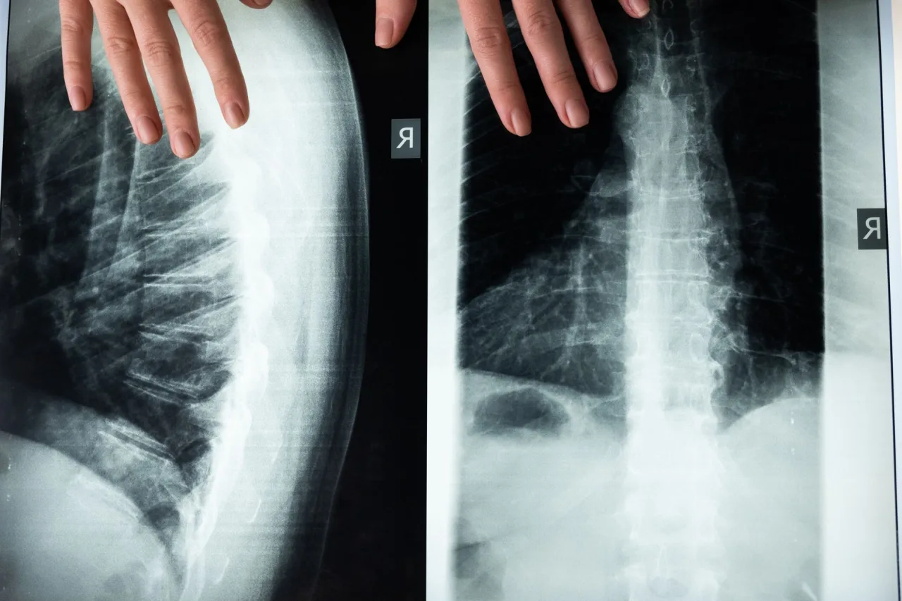 Abdominal X-Ray