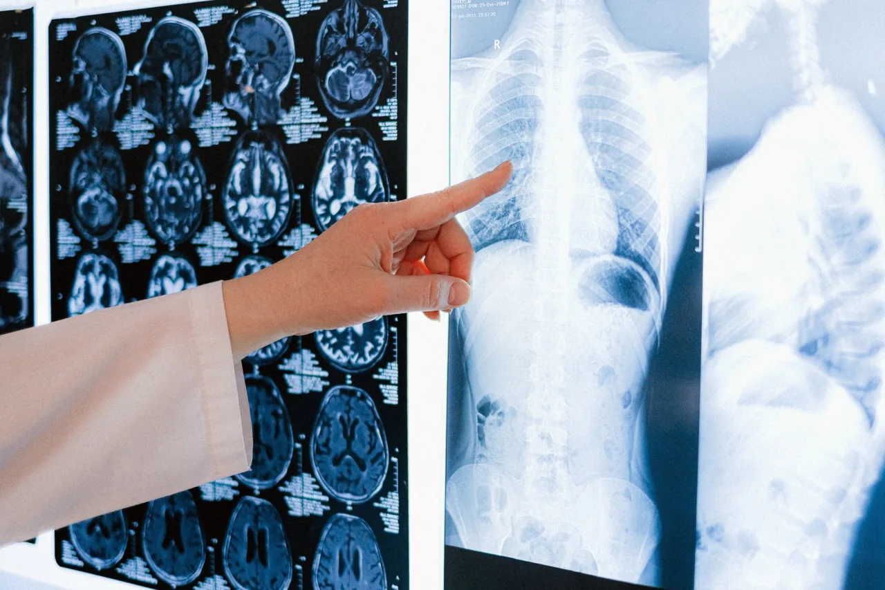 Abdominal X-Ray