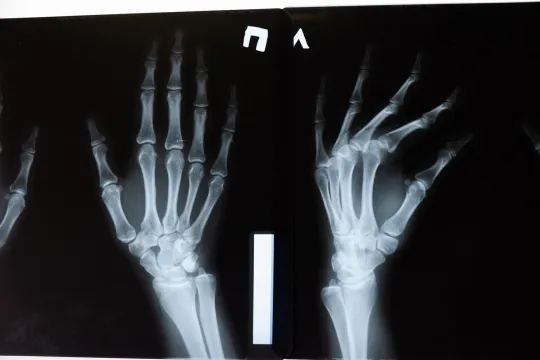 Bone Density Scan: Uses and Results
