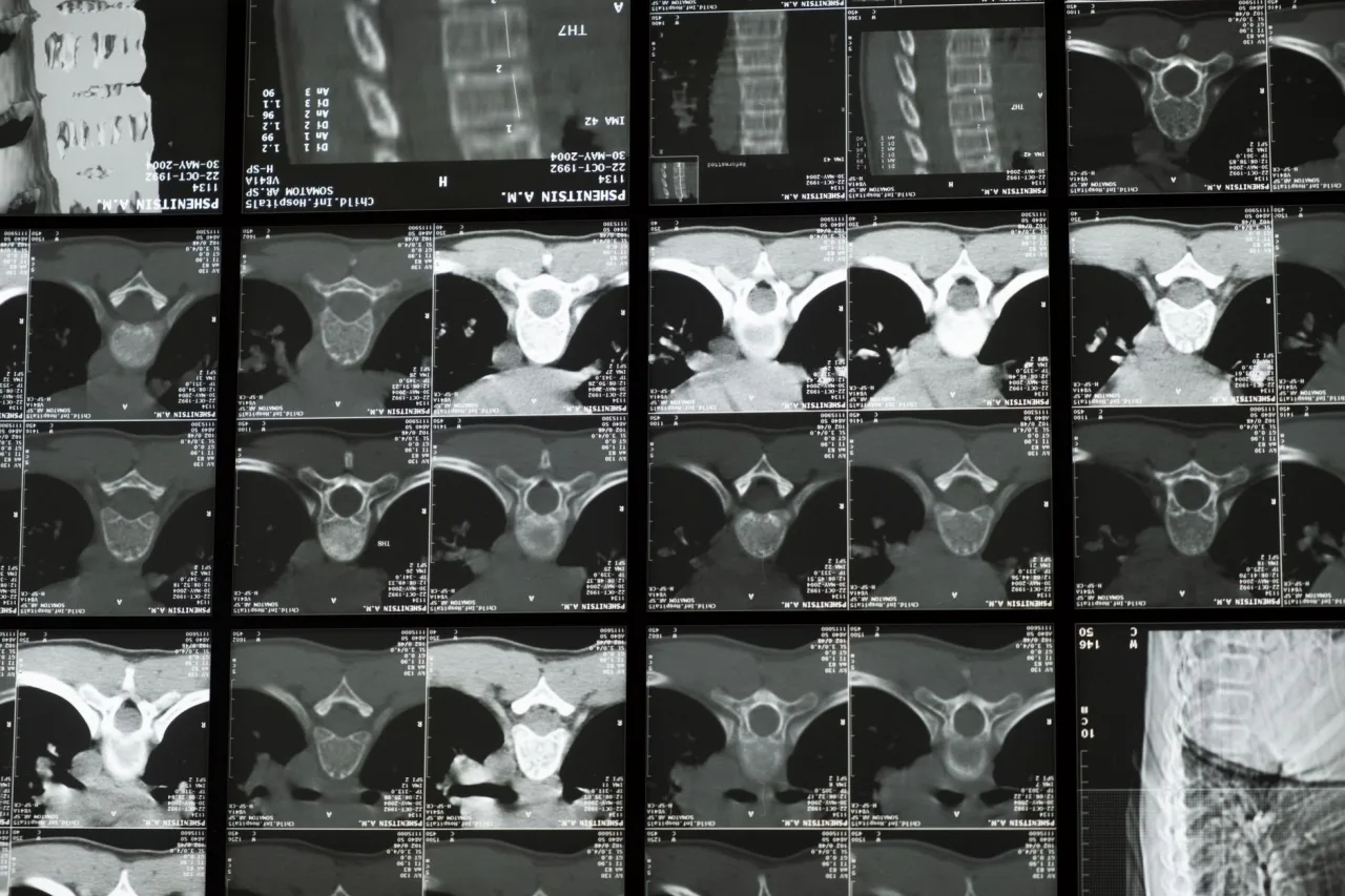 Bone Density Scan: Uses and Results