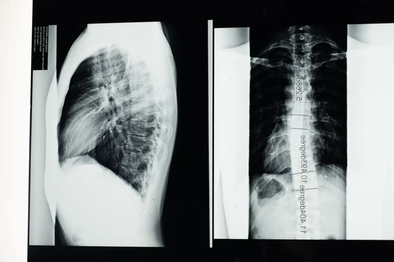 C Spine X-Ray: Uses and Procedure