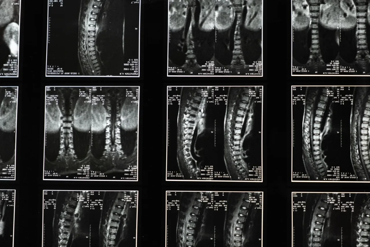 C Spine X-Ray: Uses and Procedure