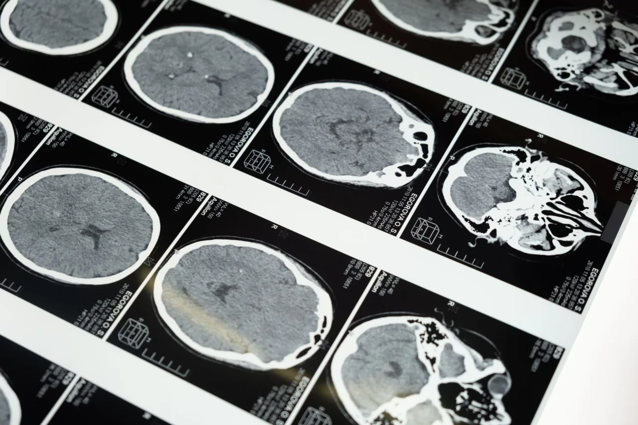 Cect Scan