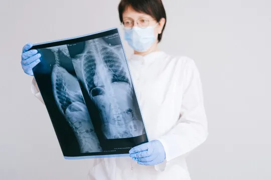 Chest X-Ray of Pneumonia