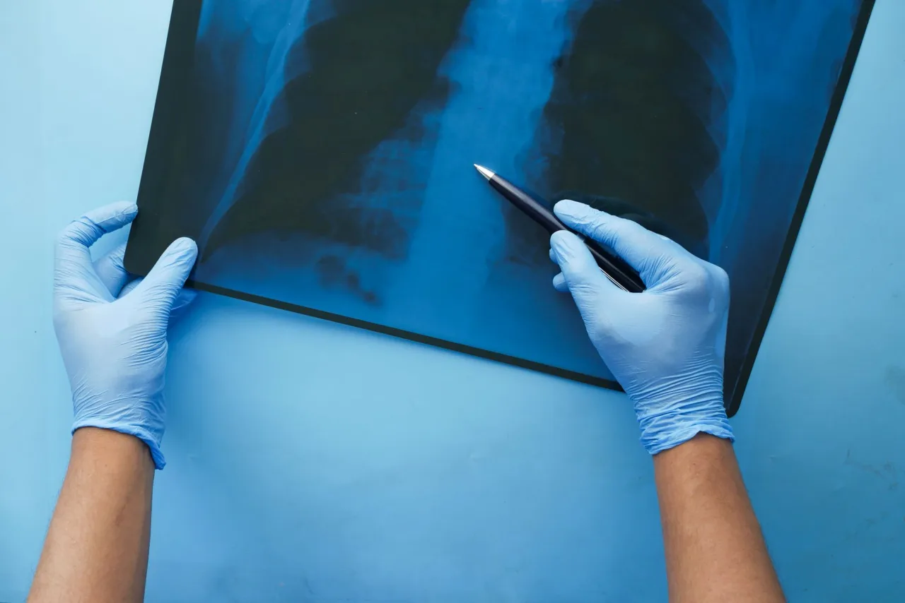 Chest X-Ray of Pneumonia