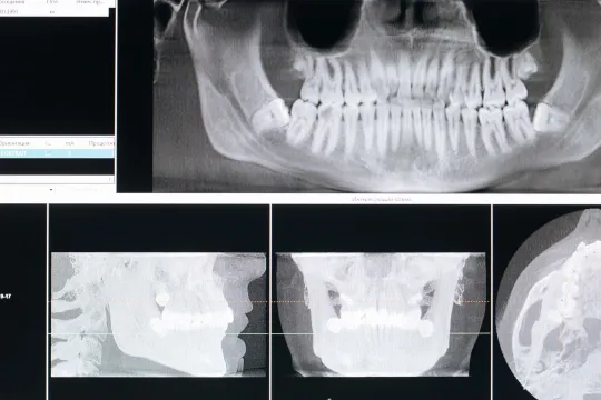 Tirads Radiology