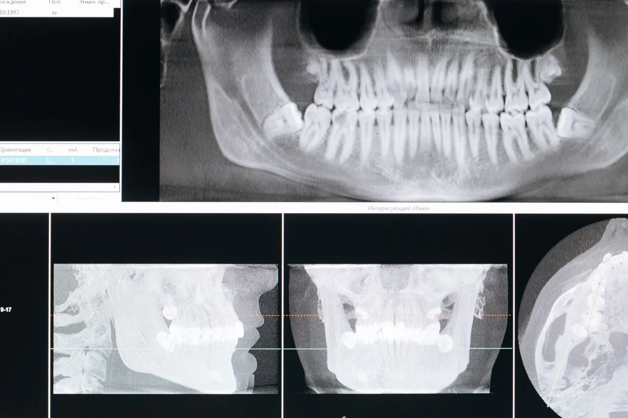 Tirads Radiology